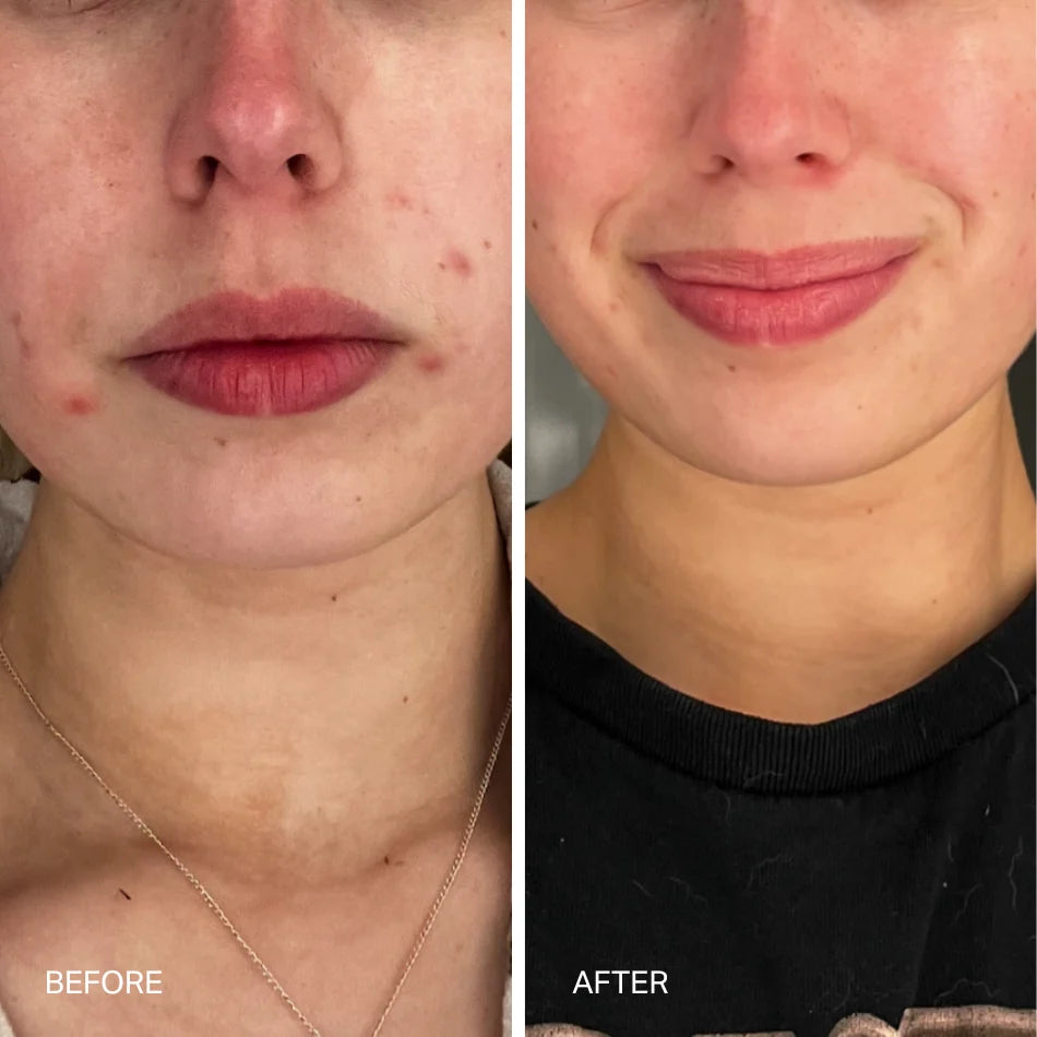 Lenox and Sixteenth - The Laser Serum